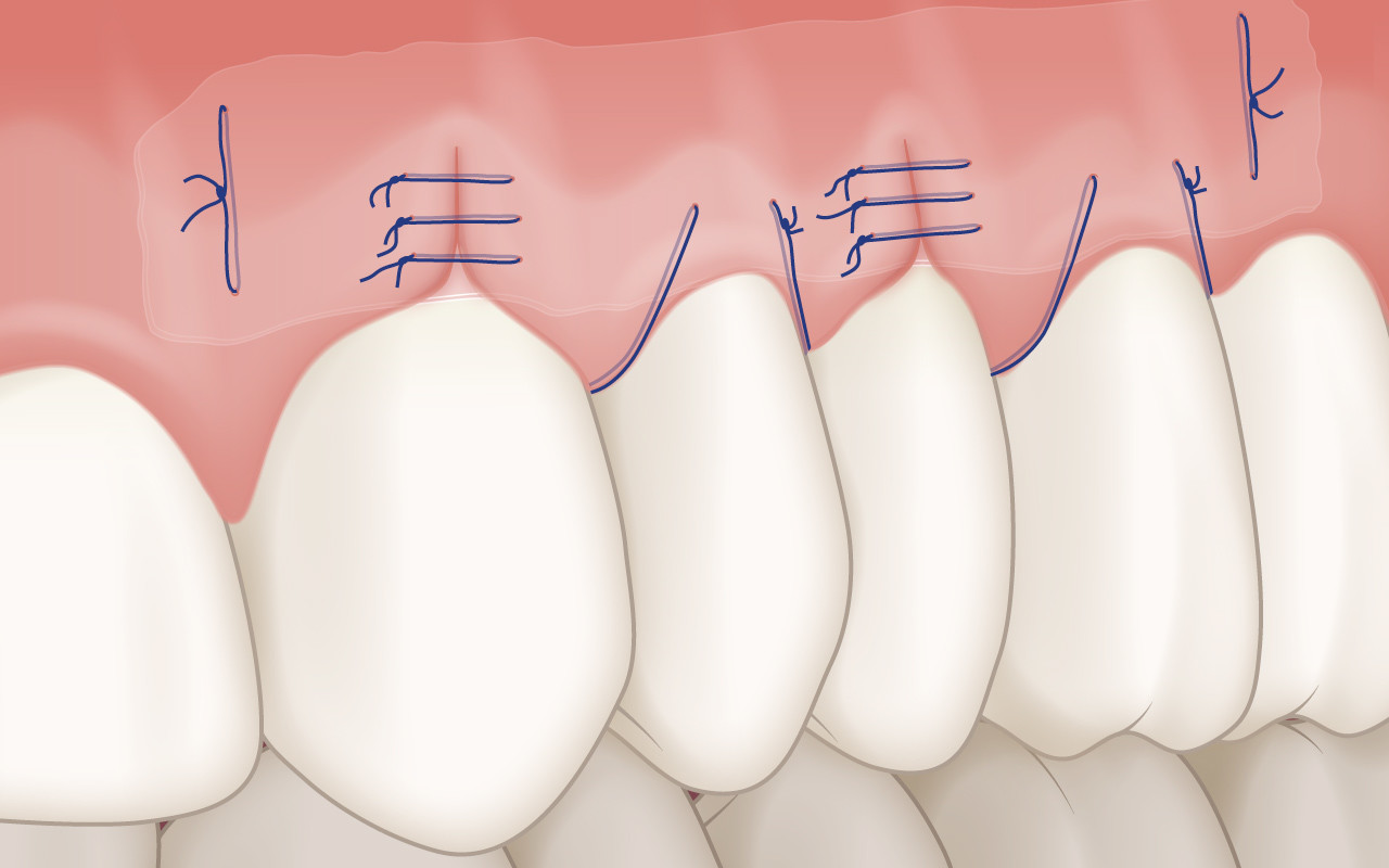 Therapie der Zahnfleischrezession