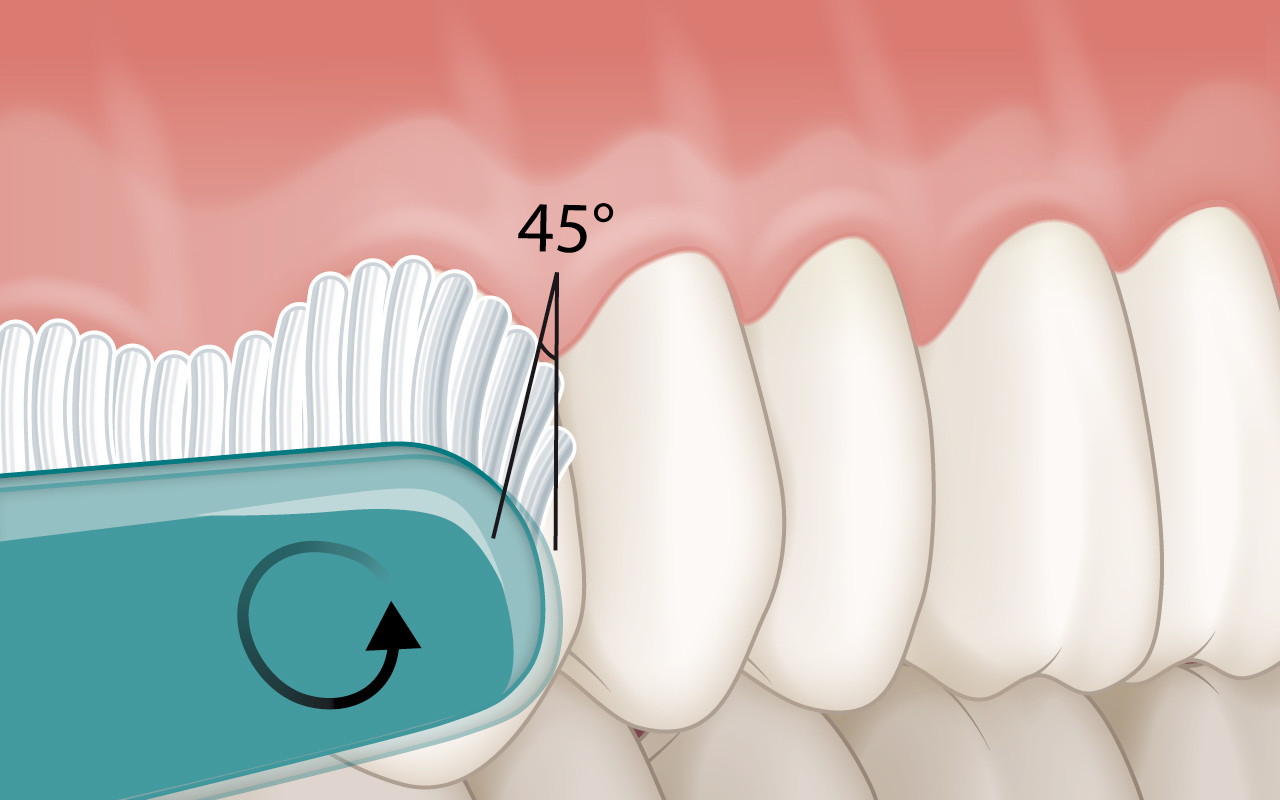 Vorbeugung der Zahnfleischrezession