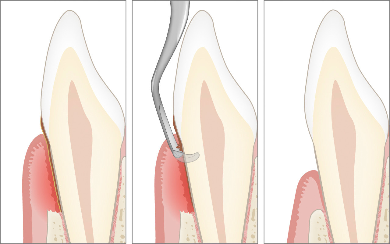Parodontalbehandlung