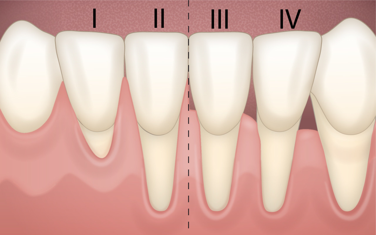Schweregrad der Zahnfleischrezession