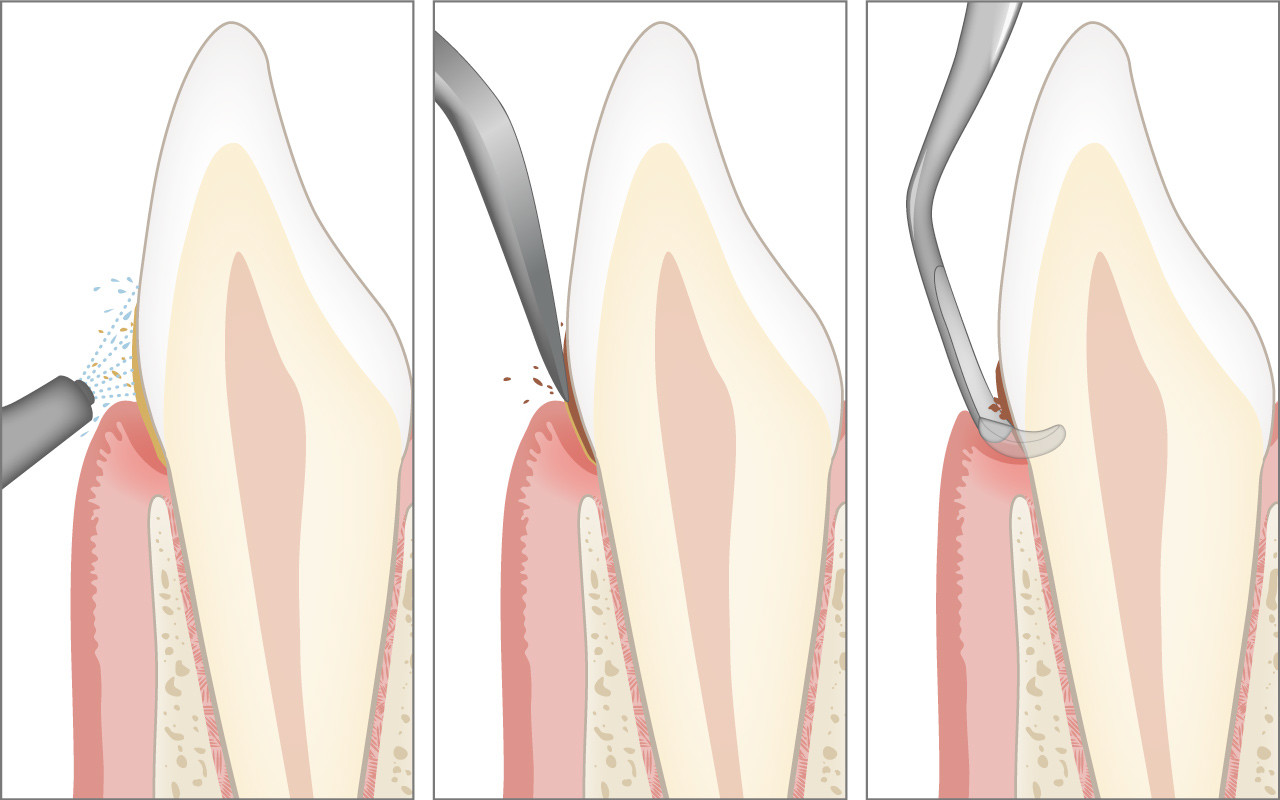 Professionelle Zahnreinigung