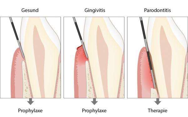 Parodontale Grunduntersuchung (PGU)